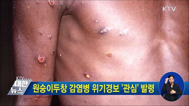 원숭이두창 감염병 위기경보 '관심' 발령